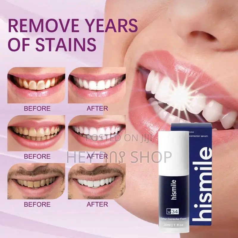 ወይንጠጁ የጥርስ ማንጫ (Purple Teeth Repair)
