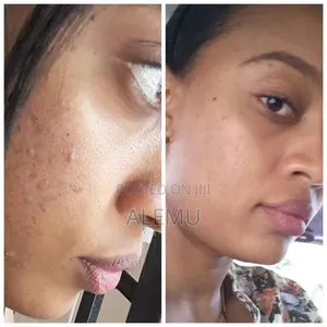 Albent Healing Clay Mask