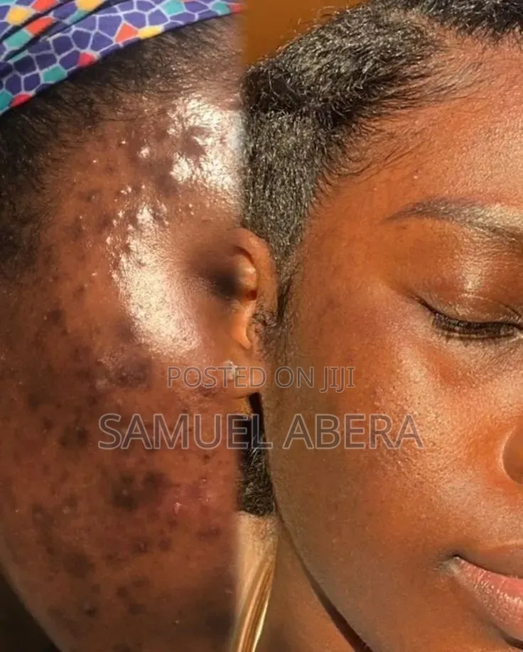 Tretinoin Cream 0.05%