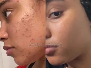 Tretinoin Cream 0.05%