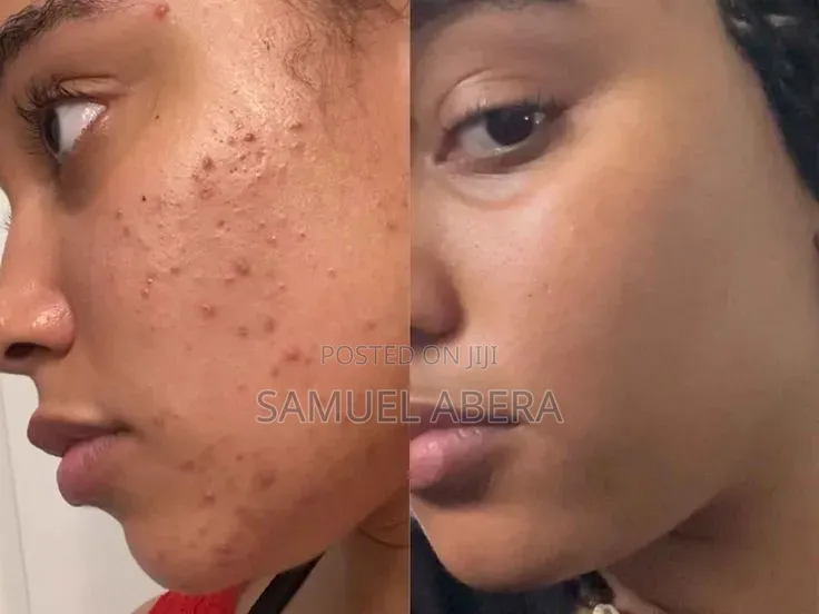 Tretinoin Cream 0.05%
