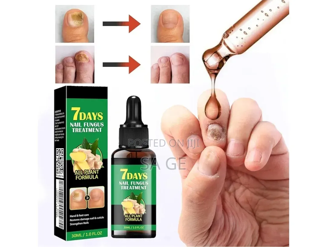 7 Days Nail Fungus Treatment(የጥፍር ማስተካከያ)