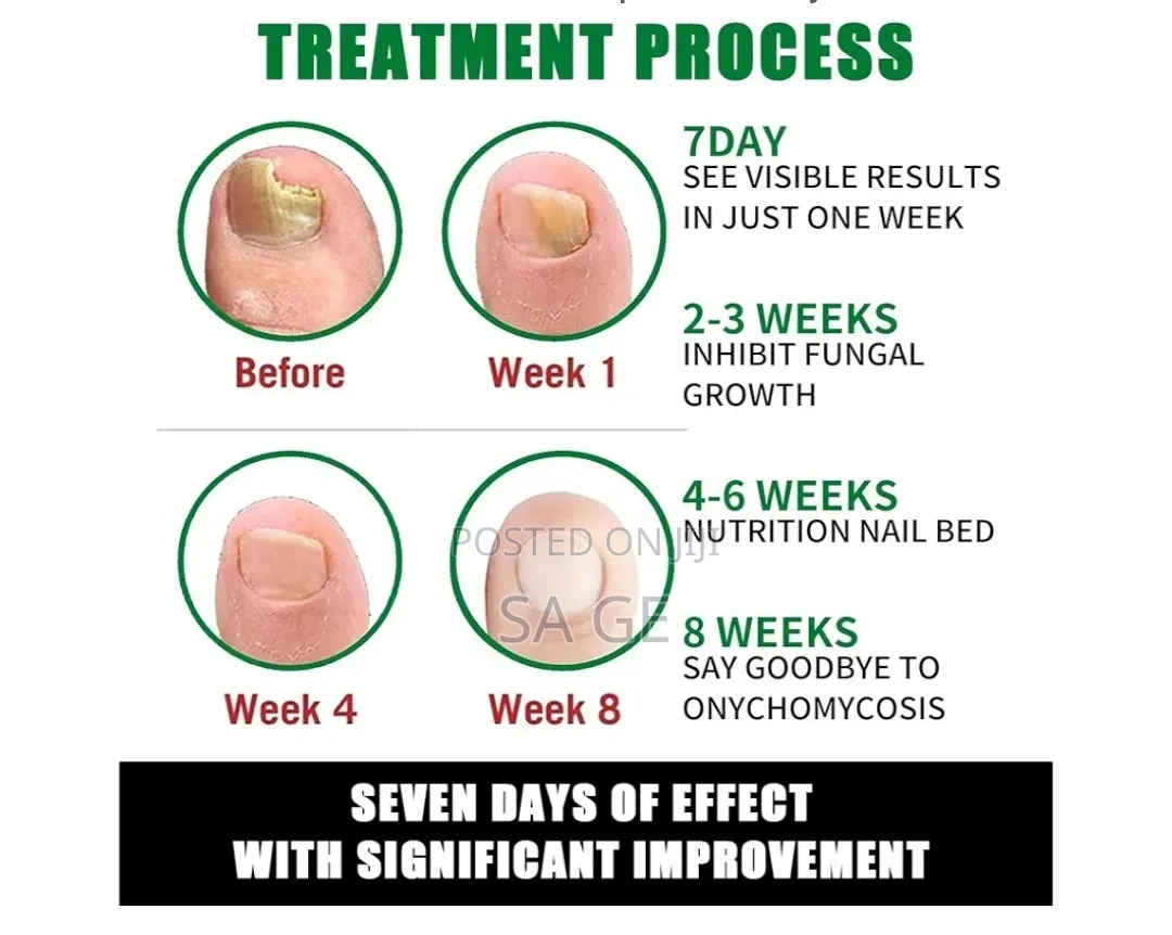 7 Days Nail Fungus Treatment(የጥፍር ማስተካከያ)