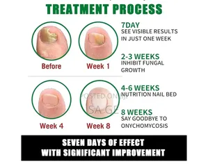 7 Days Nail Fungus Treatment(የጥፍር ማስተካከያ)
