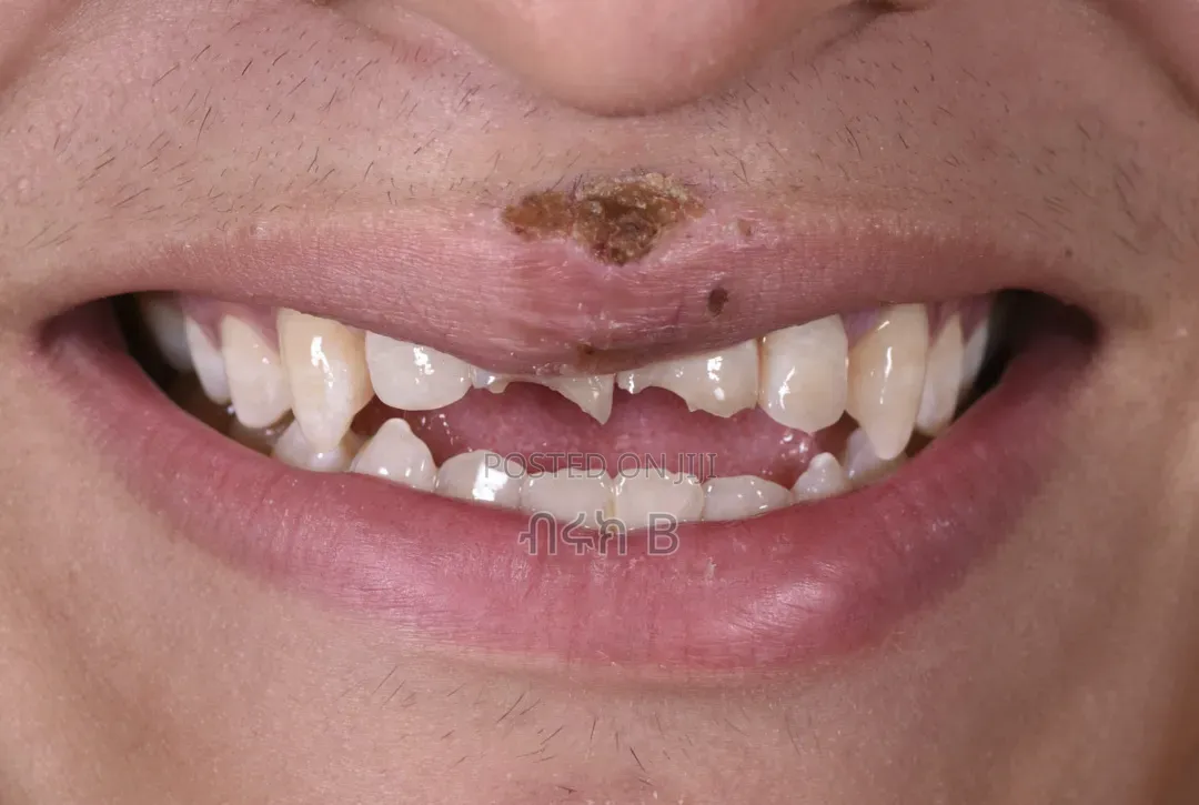 Mouth Guard