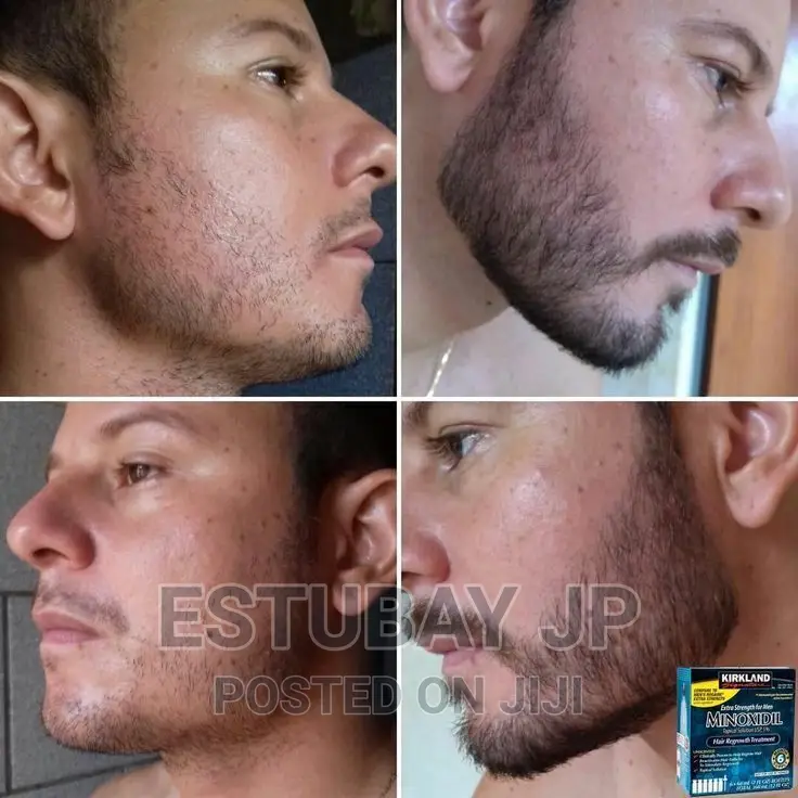 Minoxidil የወንዶች ፀጉር እና ፂም ማሳደግያ Original