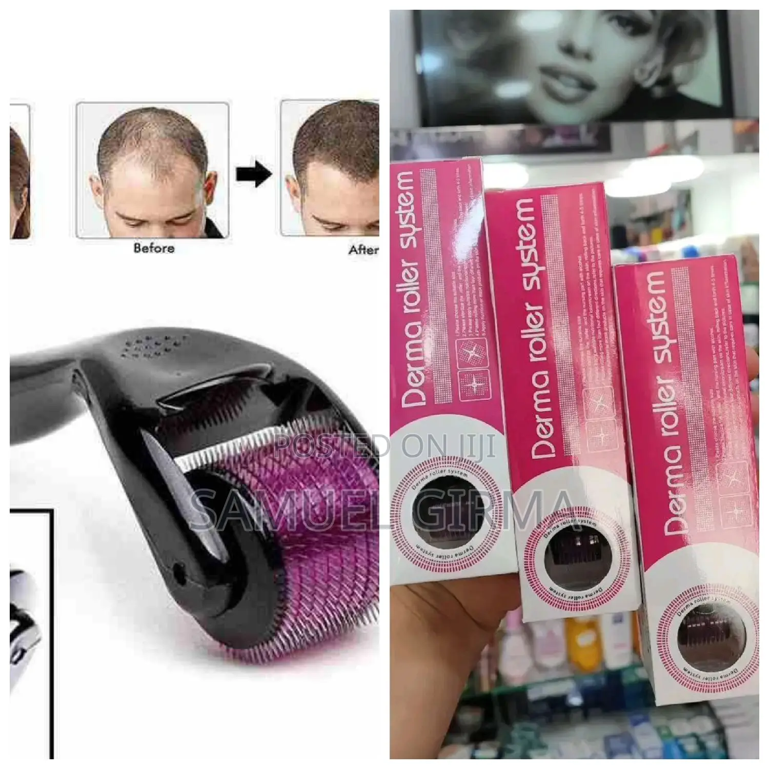 ~Derma Roller System 1.5mm With 540 Micro Needles