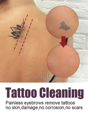 ንቅሳት ማጥፊያ Tatoo Cleaner