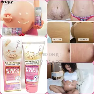 Stretch Mark Removal Cream