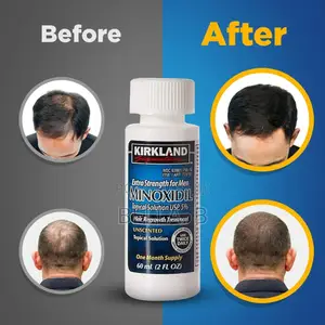 Minoxidil Gentle and Safe