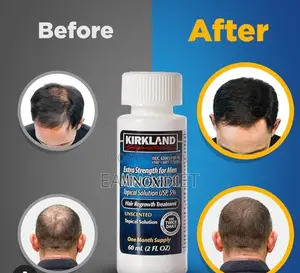 Minoxidil Usa